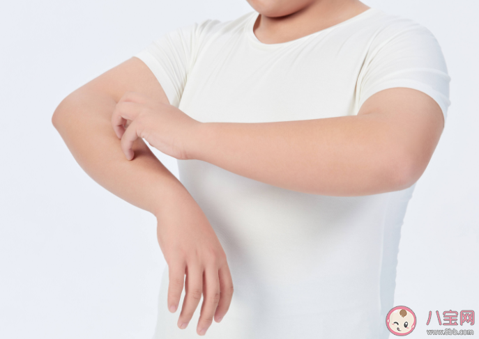 夏季孩子皮肤奇痒是湿疹吗 特应性皮炎为何青少年发病率高