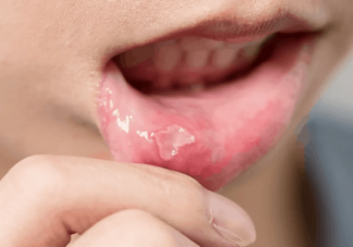 口腔溃疡患者不能吃西瓜吗 吃哪些食物口腔溃疡好得快