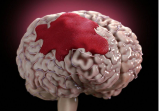 脑出血发生前有哪些预警 哪些是脑出血的危险因素