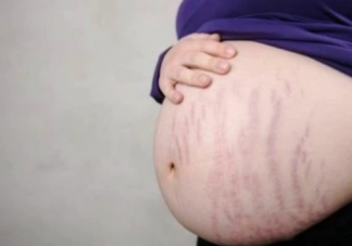 女性为什么会出现妊娠纹 如何预防孕期出现妊娠纹