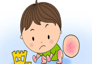 宝宝湿疹是怎么引起的 宝宝湿疹不能吃什么