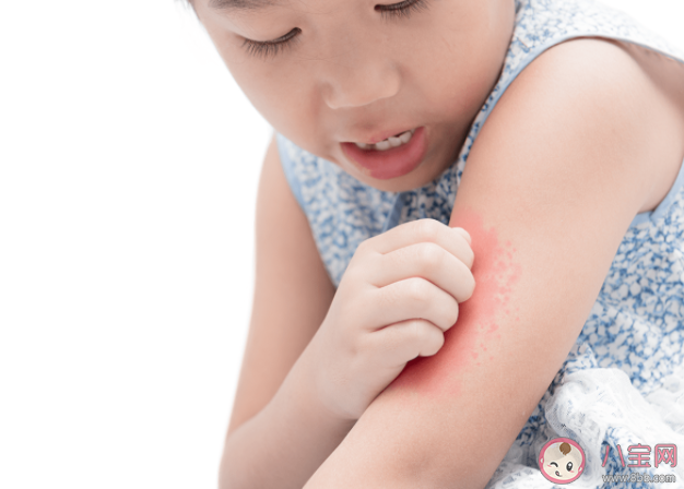 孩子荨麻疹几岁多发 荨麻疹饮食上有什么需要注意的