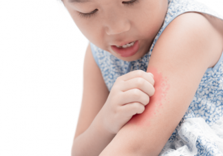 孩子荨麻疹几岁多发 荨麻疹饮食上有什么需要注意的