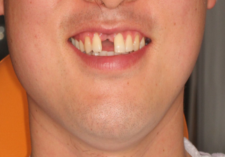 缺牙让预期寿命缩短11.7年 牙齿缺失有什么危害