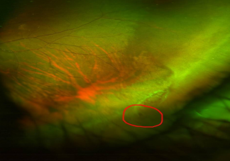 考研女生用眼过度视网膜裂孔 视网膜裂孔有什么症状