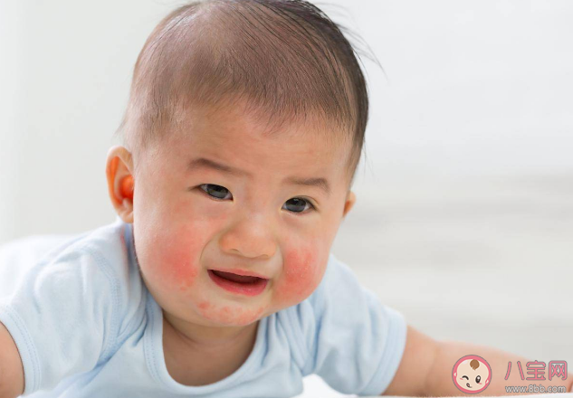 婴幼儿湿疹发病率有多高 如何预防孩子湿疹的发生和复发