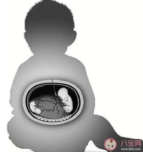 3周大女婴肚子里取出8个寄生胎 什么是寄生胎