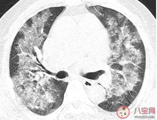 白肺是什么疾病 白肺病会传染吗