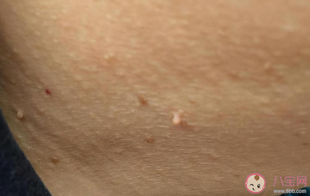 丝状疣|丝状疣需要治疗吗 丝状疣跟女性宫颈HPV有关系吗