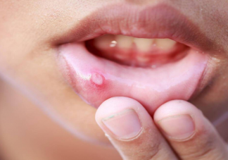 经常烂嘴角可能是免疫力差 如何科学提高自身的免疫力