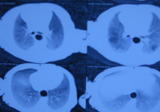 为什么近期白肺患者逐渐增多 导致白肺的原因是什么