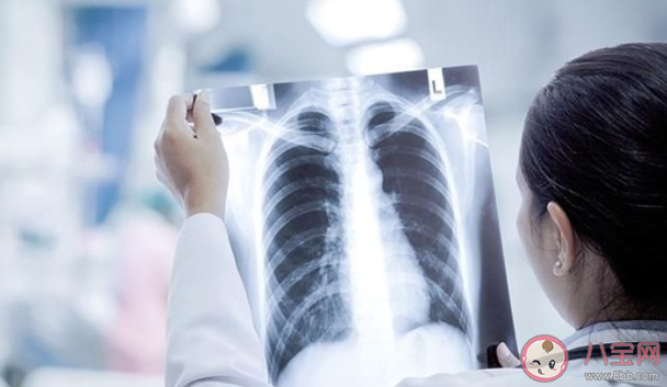 白肺与原始毒株和疫苗接种没关系 新冠为什么会导致白肺病例出现