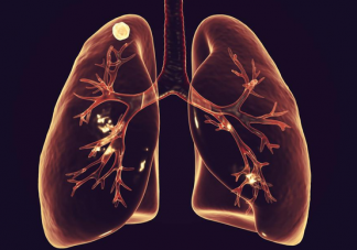 专家回应肺要咳出来要拍CT吗 哪些情况要拍肺部拍CT