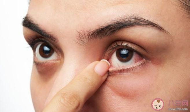 新冠病毒很可能存在眼部趋向性 新冠感染眼部护理要注意什么