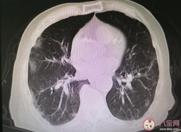 哪些症状需要去医院排查白肺 哪些人容易产生白肺