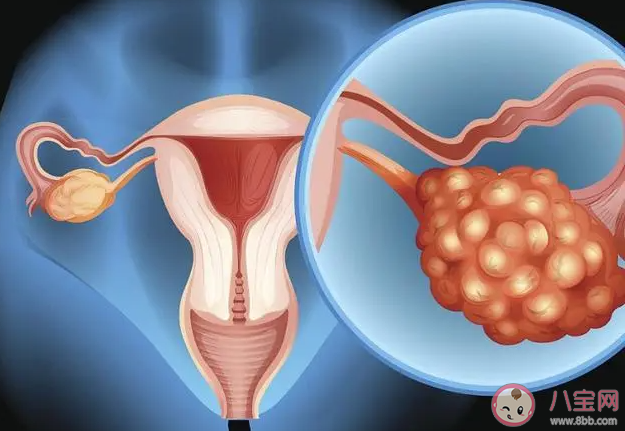 女孩总喊腹痛被说厌学查出恶性肿瘤 早期卵巢生殖细胞恶性肿瘤是什么原因