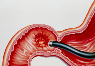 呼气实验能够替代胃镜吗 什么人需要进行胃镜检查