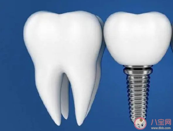 多地调低种植牙医疗服务费用 什么情况下需要种牙