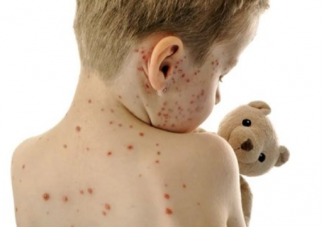 水痘进入高发期专家提醒 水痘该如何预防