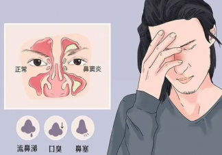 为什么一到换季就鼻炎 该如何应对过敏性鼻炎