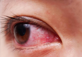眼睛里的红血丝是什么 护眼如何内外兼顾