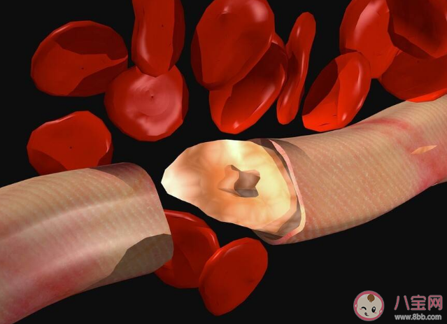 血管细的人更容易得血栓吗 血管变窄对身体有什么影响