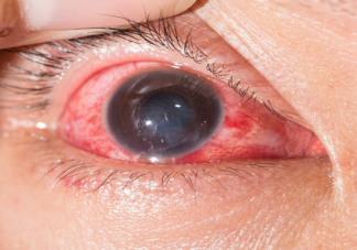 新冠新毒株或致红眼病该囤眼药水吗 出现结膜炎怎么办