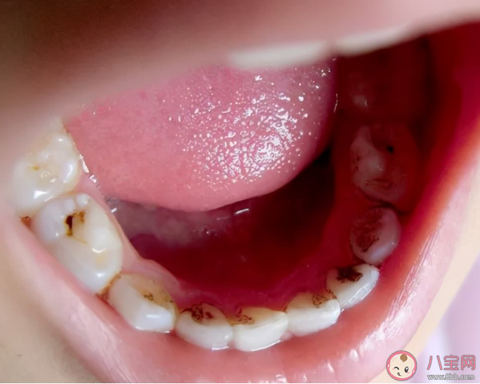 儿童用氟化泡沫有用吗 涂了氟的牙齿就不会坏了吗