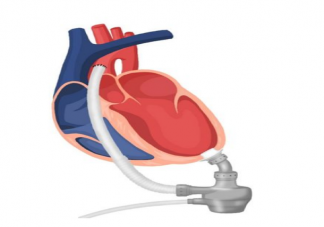 全国首例心脏不停跳人工心脏植入 突破性技术对心脏疾病有何意义