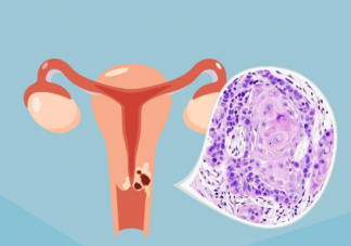 子宫内膜癌做试管有影响吗 子宫内膜癌有哪些危险因素