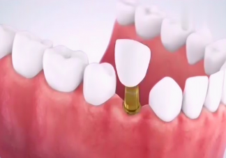 种植牙使用寿命为什么相差这么大 种植牙与天然牙有何不同