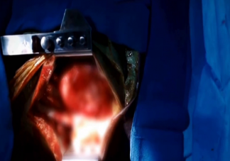 首位猪心移植患者心衰原因公布 猪心移植手术的原理是什么