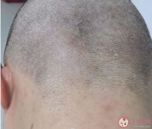 头皮上长痂能不能抠 脂溢性皮炎可以根治吗