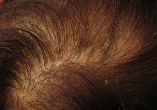 头皮上长痂能不能抠 脂溢性皮炎可以根治吗