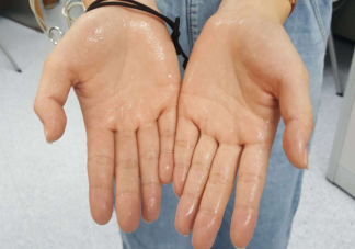 手汗症有轻重之分吗 手汗症和遗传有关吗