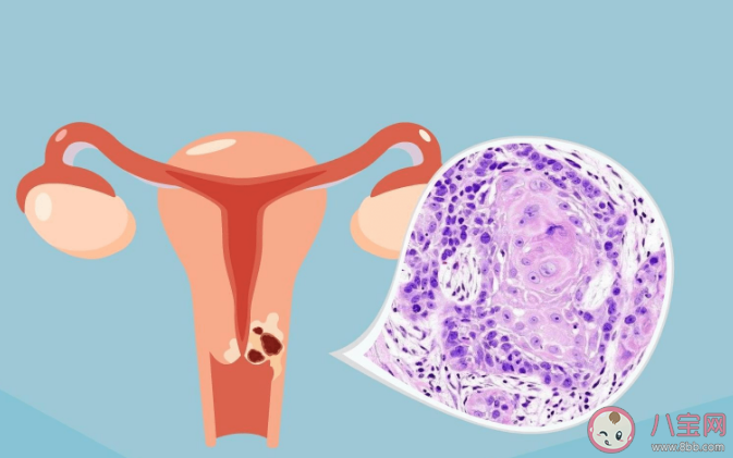 卵巢癌有什么特点 如何提高卵巢癌发现率