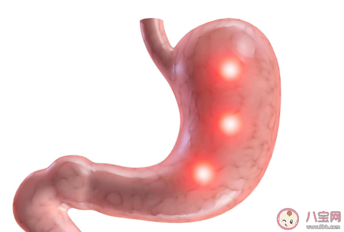 胃溃疡严重吗会出现哪些并发症 胃溃疡可以从哪些方面预防