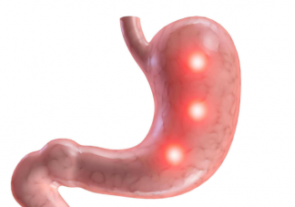 胃溃疡严重吗会出现哪些并发症 胃溃疡可以从哪些方面预防