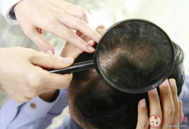 头皮护理防脱有什么技巧 脱发最主要的原因是什么