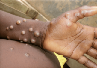 出现女性猴痘感染者意味着什么 猴痘是如何传播的