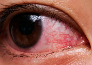 和红眼病人对视会被传染吗 家里有人得了红眼病怎么办