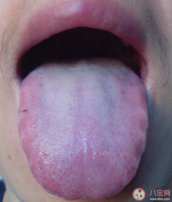 舌苔白厚正常吗 舌苔到底是什么