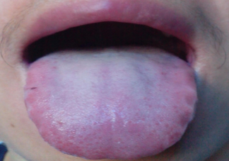 舌苔白厚正常吗 舌苔到底是什么
