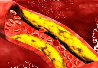 科学降血脂应该怎么做 血脂为什么会高
