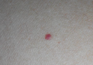 皮肤上的小红点是什么 哪些皮肤瘤不用管