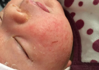 孩子湿疹治不好可能和这些原因有关 婴儿湿疹有哪些类型