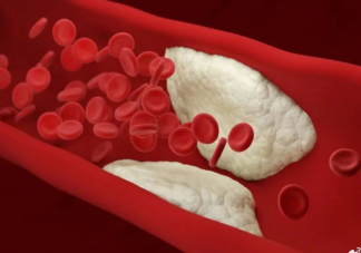 如何知道血管里有没有斑块 血管中哪种斑块更有希望逆转