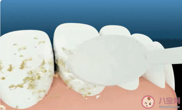 牙菌斑过多的表现有哪些 牙齿长牙菌斑了怎么办