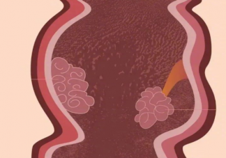 为什么一发现肠息肉就要切除 哪3种息肉易癌变