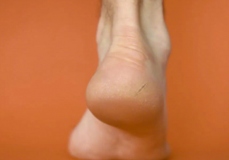 脚后跟干裂可能是3种病 脚后跟干裂该怎么办